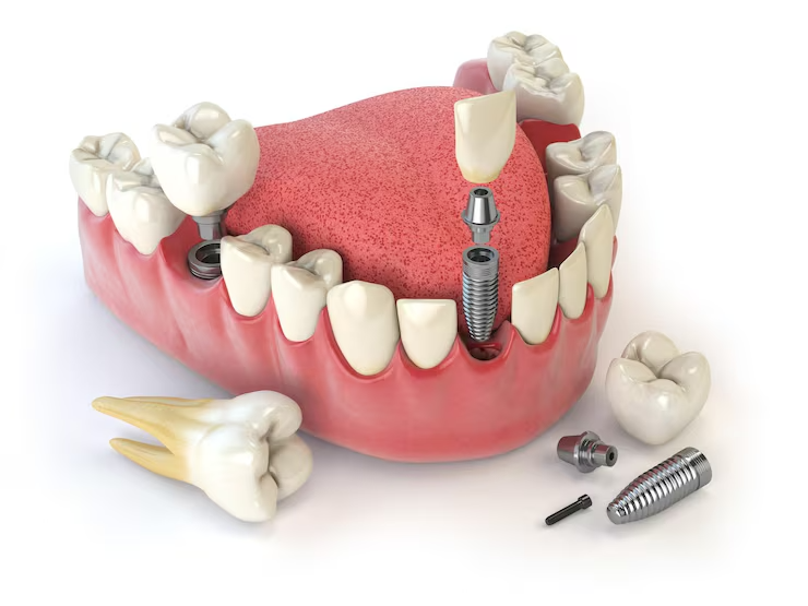 Can dental implants help with speech problems caused by missing teeth dental implants near me